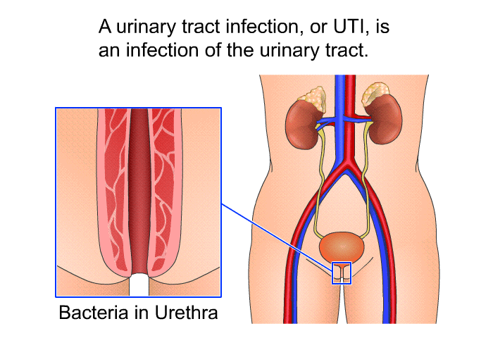 A urinary tract infection, or UTI, is an infection of the urinary tract.