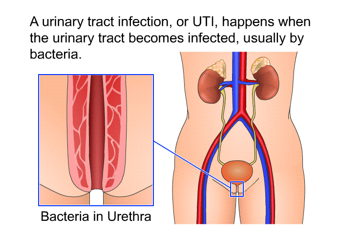 A urinary tract infection, or UTI, happens when the urinary tract becomes infected, usually by bacteria.