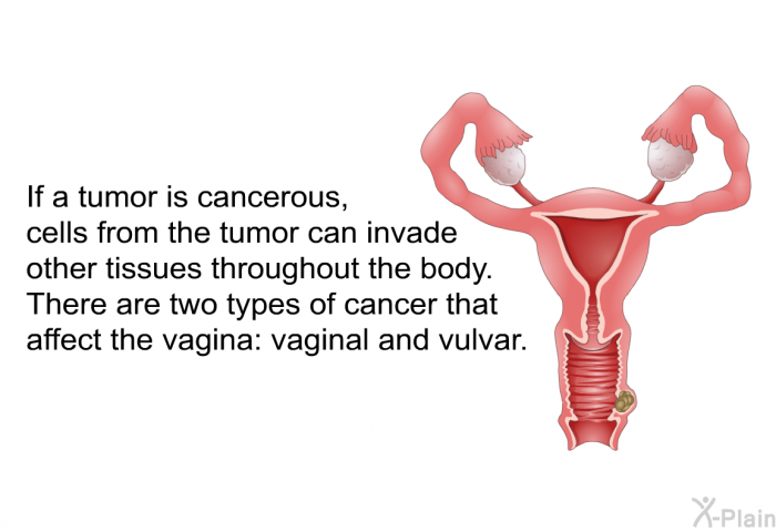 If a tumor is cancerous, cells from the tumor can invade other tissues throughout the body. There are two types of cancer that affect the vagina: vaginal and vulvar.