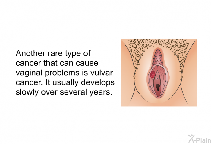 Another rare type of cancer that can cause vaginal problems is vulvar cancer. It usually develops slowly over several years.