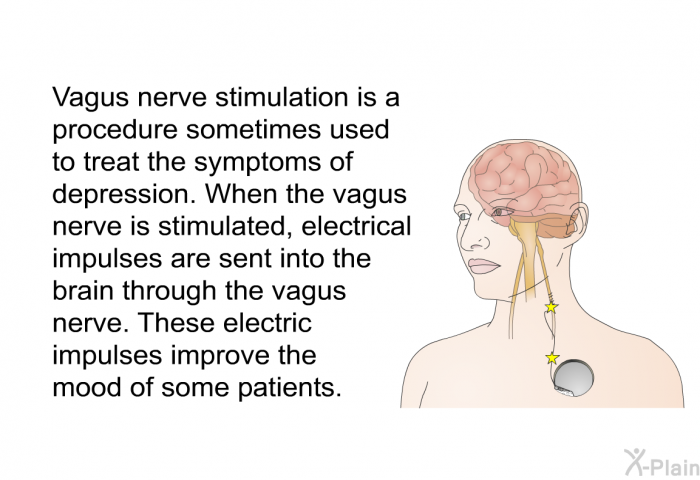 Vagus nerve stimulation is a procedure sometimes used to treat the symptoms of depression. When the vagus nerve is stimulated, electrical impulses are sent into the brain through the vagus nerve. These electric impulses improve the mood of some patients.