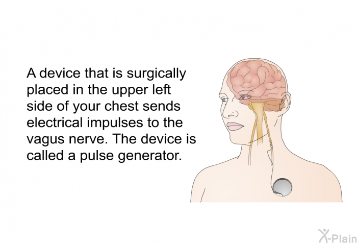 A device that is surgically placed in the upper left side of your chest sends electrical impulses to the vagus nerve. The device is called a pulse generator.