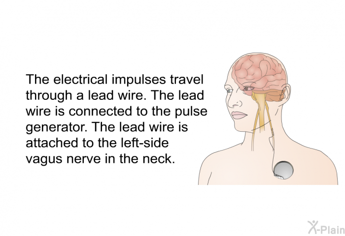 The electrical impulses travel through a lead wire. The lead wire is connected to the pulse generator. The lead wire is attached to the left-side vagus nerve in the neck.