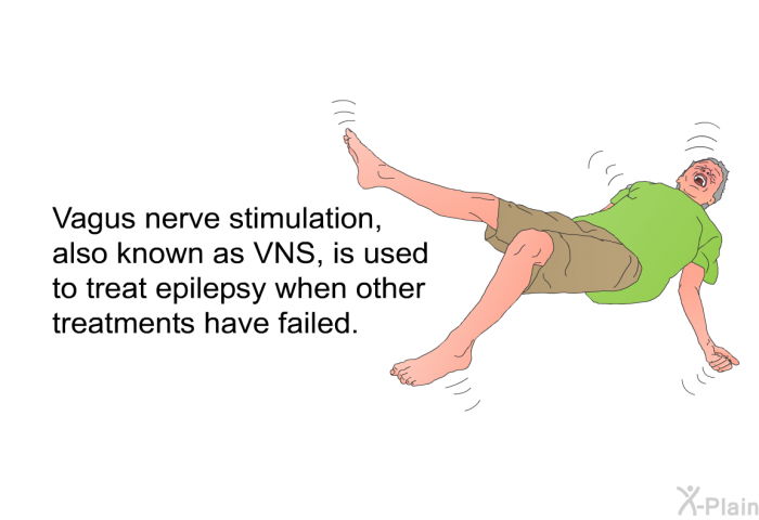 Vagus nerve stimulation, also known as VNS, is used to treat epilepsy when other treatments have failed.