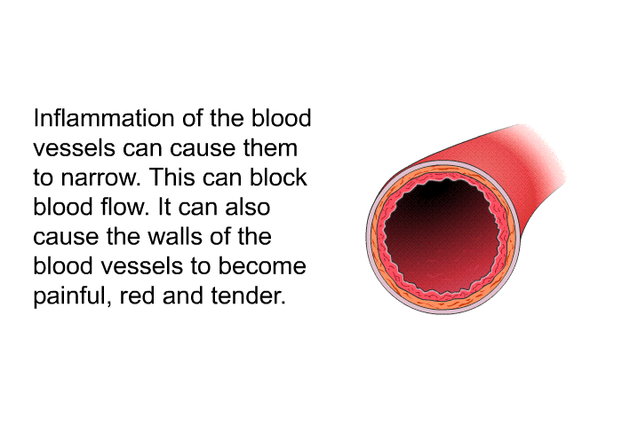 Inflammation of the blood vessels can cause them to narrow. This can block blood flow. It can also cause the walls of the blood vessels to become painful, red and tender.