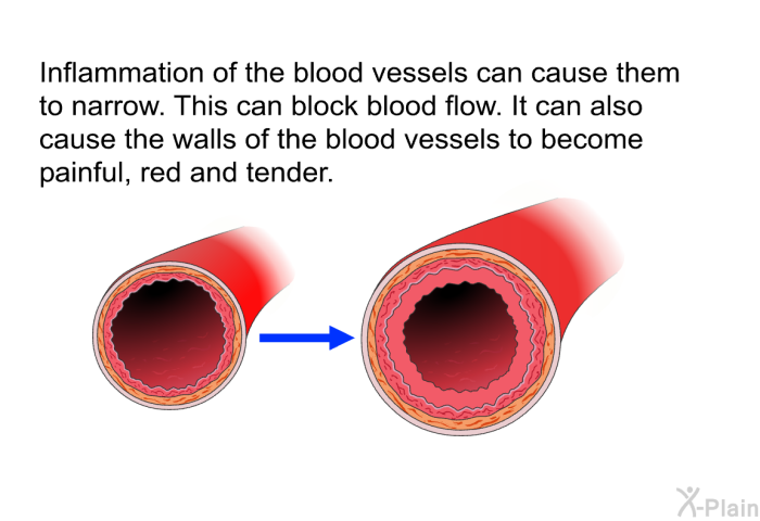 Inflammation of the blood vessels can cause them to narrow. This can block blood flow. It can also cause the walls of the blood vessels to become painful, red and tender.
