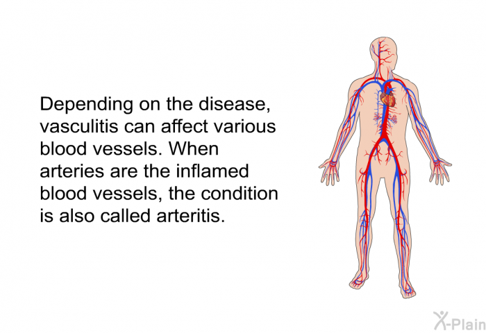 Depending on the disease, vasculitis can affect various blood vessels. When arteries are the inflamed blood vessels, the condition is also called arteritis.
