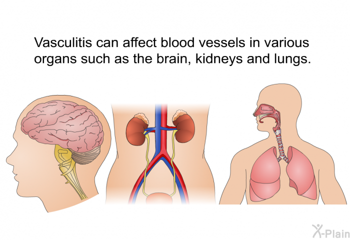 Vasculitis can affect blood vessels in various organs such as the brain, kidneys and lungs.