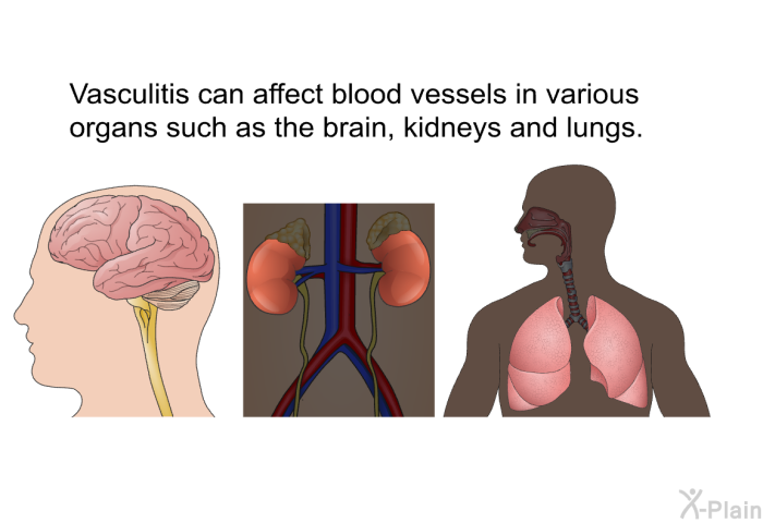 Vasculitis can affect blood vessels in various organs such as the brain, kidneys and lungs.