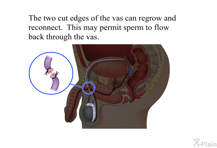 The two cut edges of the vas can regrow and reconnect. This may permit sperm to flow back through the vas.
