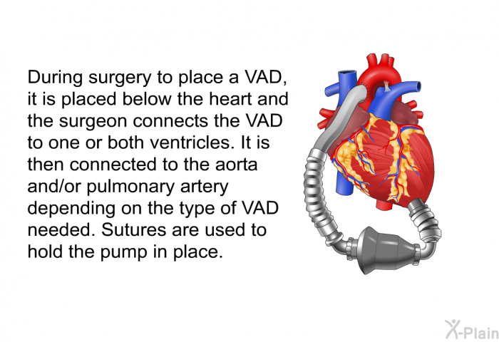 During surgery to place a VAD, it is placed below the heart and the surgeon connects the VAD to one or both ventricles. It is then connected to the aorta and/or pulmonary artery depending on the type of VAD needed. Sutures are used to hold the pump in place.