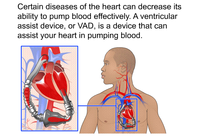 Certain diseases of the heart can decrease its ability to pump blood effectively. A ventricular assist device, or VAD, is a device that can assist your heart in pumping blood.
