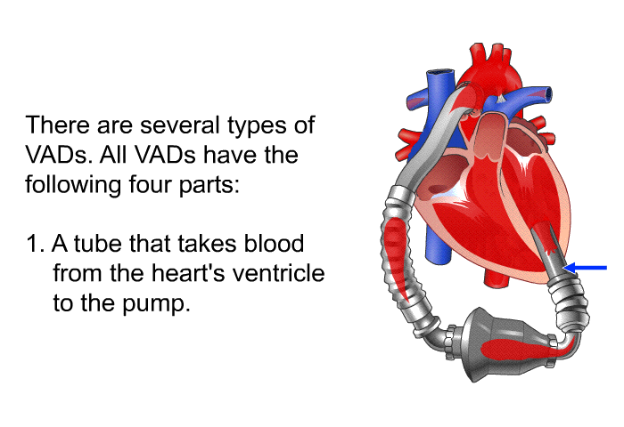 There are several types of VADs. All VADs have the following four parts:  A tube that takes blood from the heart's ventricle to the pump.