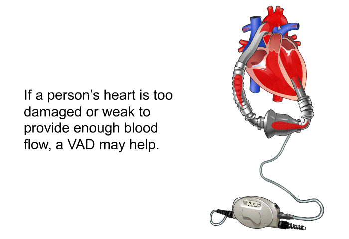 If a person's heart is too damaged or weak to provide enough blood flow, a VAD may help.