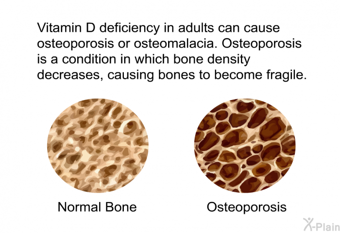 Vitamin D deficiency in adults can cause osteoporosis or osteomalacia. Osteoporosis is a condition in which bone density decreases, causing bones to become fragile.