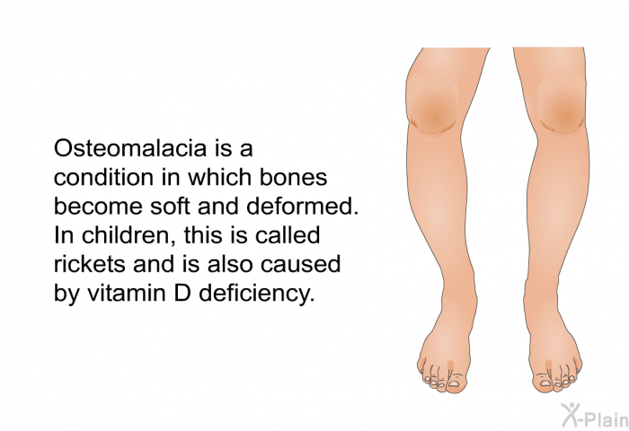 Osteomalacia is a condition in which bones become soft and deformed. In children, this is called rickets and is also caused by vitamin D deficiency.