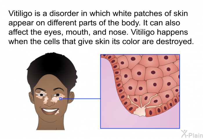 Vitiligo is a disorder in which white patches of skin appear on different parts of the body. It can also affect the eyes, mouth, and nose. Vitiligo happens when the cells that give skin its color are destroyed.
