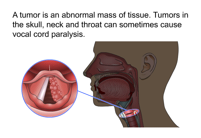 A tumor is an abnormal mass of tissue. Tumors in the skull, neck and throat can sometimes cause vocal cord paralysis.