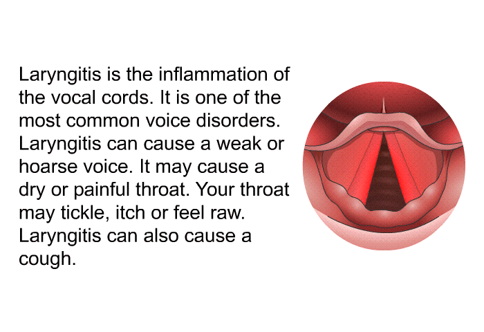 Laryngitis is the inflammation of the vocal cords. It is one of the most common voice disorders. Laryngitis can cause a weak or hoarse voice. It may cause a dry or painful throat. Your throat may tickle, itch or feel raw. Laryngitis can also cause a cough.