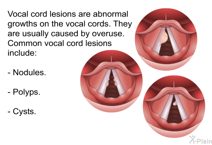Vocal cord lesions are abnormal growths on the vocal cords. They are usually caused by overuse. Common vocal cord lesions include:  Nodules. Polyps. Cysts.