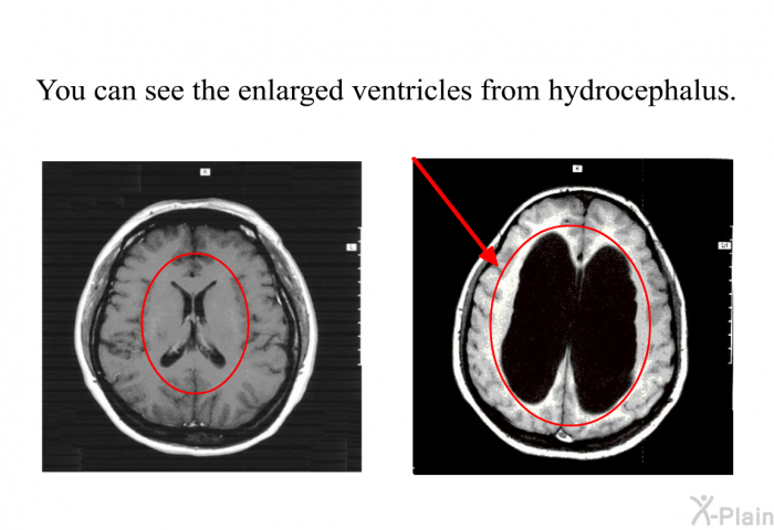 You can see the enlarged ventricles from hydrocephalus.