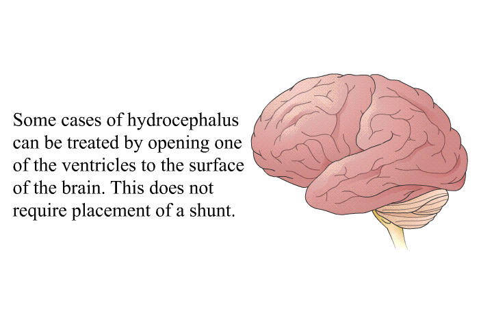 Some cases of hydrocephalus can be treated by opening one of the ventricles to the surface of the brain. This does not require the placement of a shunt.