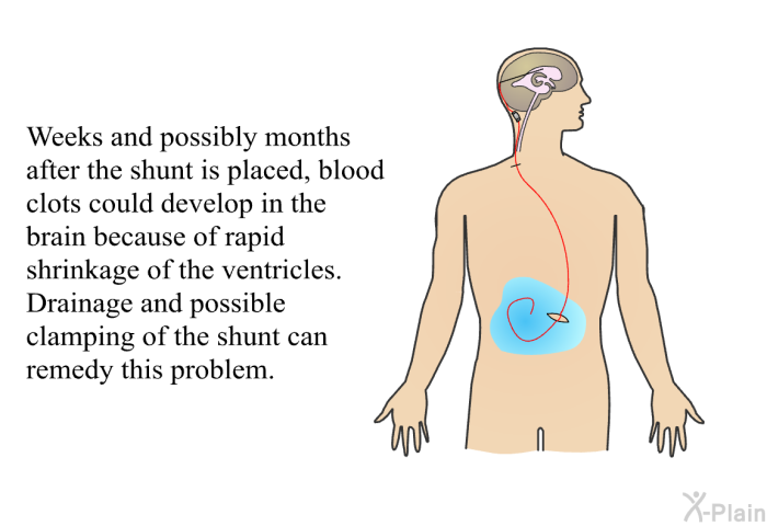 Weeks and possibly months after the shunt is placed, blood clots could develop in the brain because of rapid shrinkage of the ventricles. Drainage and possible clamping of the shunt can remedy this problem.