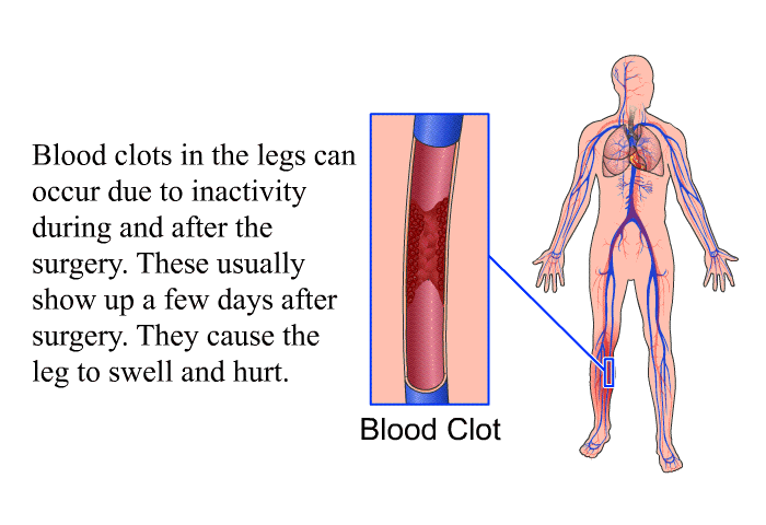 Blood clots in the legs can occur due to inactivity during and after the surgery. These usually show up a few days after surgery. They cause the leg to swell and hurt.