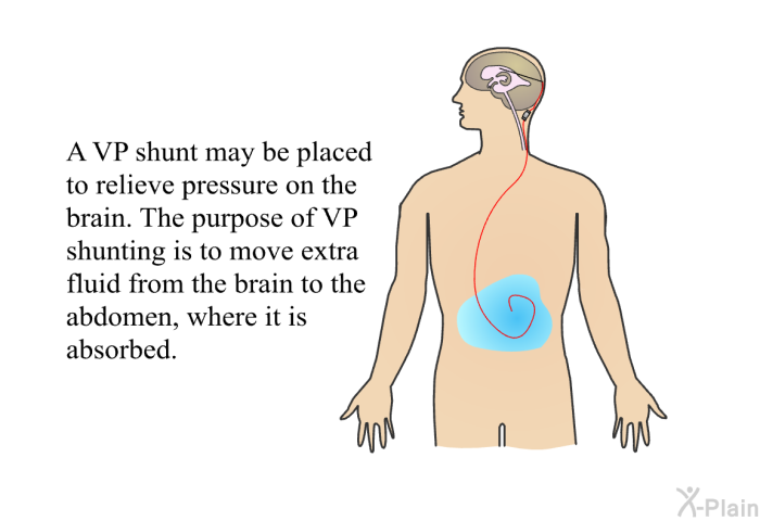 A VP shunt may be placed to relieve pressure on the brain. The purpose of VP shunting is to move extra fluid from the brain to the abdomen, where it is absorbed.