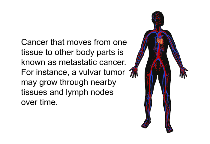 Cancer that moves from one tissue to other body parts is known as metastatic cancer. For instance, a vulvar tumor may grow through nearby tissues and lymph nodes over time.