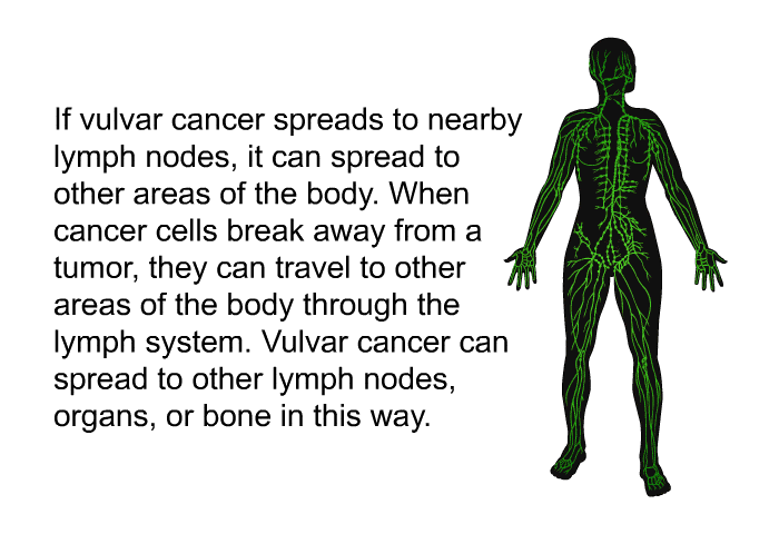 If vulvar cancer spreads to nearby lymph nodes, it can spread to other areas of the body. When cancer cells break away from a tumor, they can travel to other areas of the body through the lymph system. Vulvar cancer can spread to other lymph nodes, organs, or bone in this way.