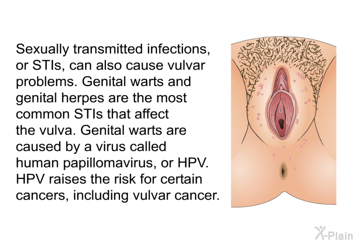 Sexually transmitted infections, or STIs, can also cause vulvar problems. Genital warts and genital herpes are the most common STIs that affect the vulva. Genital warts are caused by a virus called human papillomavirus, or HPV. HPV raises the risk for certain cancers, including vulvar cancer.