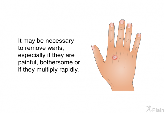 It may be necessary to remove warts, especially if they are painful, bothersome or if they multiply rapidly.