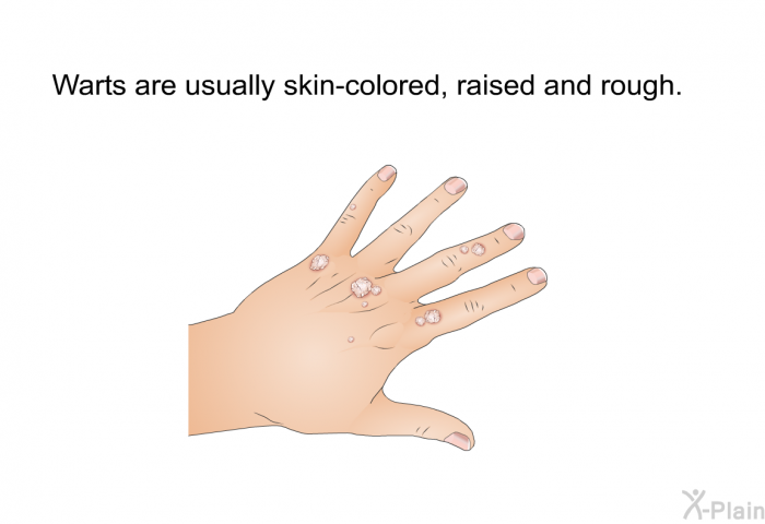 Warts are usually skin-colored, raised and rough.