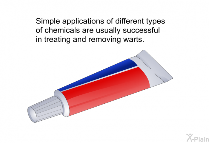Simple applications of different types of chemicals are usually successful in treating and removing warts.