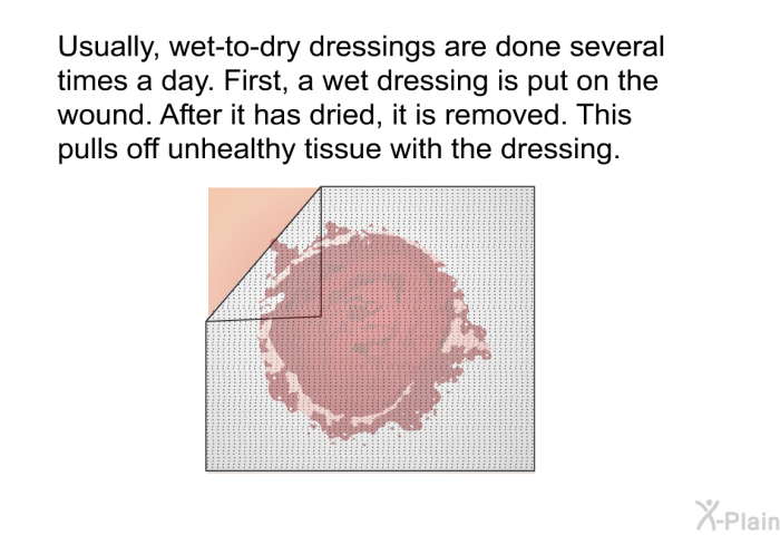 Usually, wet-to-dry dressings are done several times a day. First, a wet dressing is put on the wound. After it has dried, it is removed. This pulls off unhealthy tissue with the dressing.