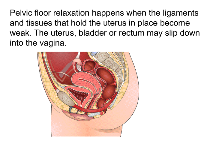 Pelvic floor relaxation happens when the ligaments and tissues that hold the uterus in place become weak. The uterus, bladder or rectum may slip down into the vagina.
