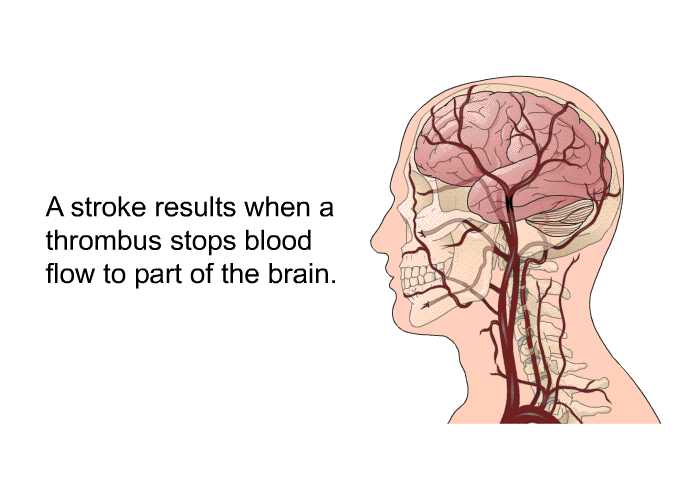 A stroke results when a thrombus stops blood flow to part of the brain.