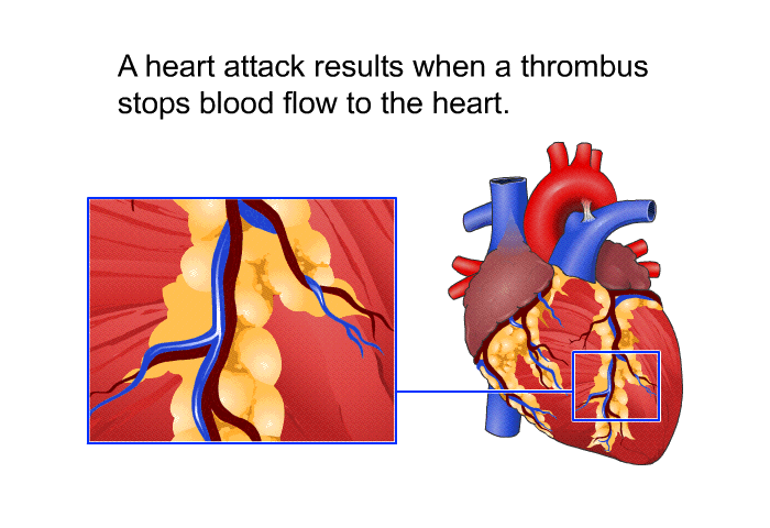 A heart attack results when a thrombus stops blood flow to the heart.