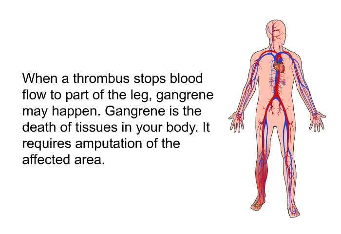When a thrombus stops blood flow to part of the leg, gangrene may happen. Gangrene is the death of tissues in your body. It requires amputation of the affected area.