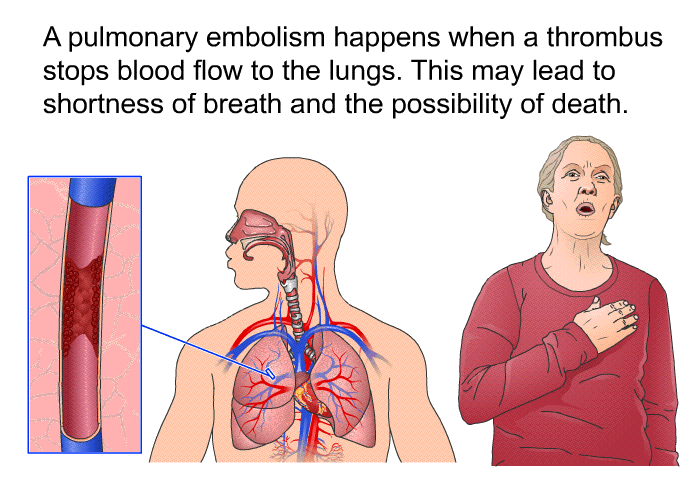 A pulmonary embolism happens when a thrombus stops blood flow to the lungs. This may lead to shortness of breath and the possibility of death.