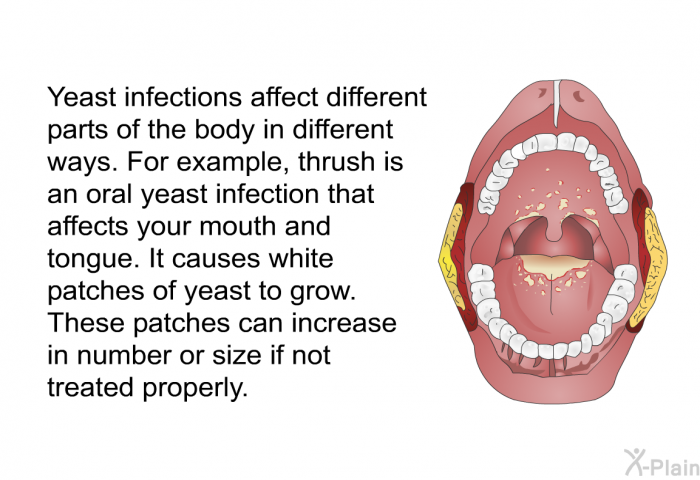 Yeast infections affect different parts of the body in different ways. For example, thrush is an oral yeast infection that affects your mouth and tongue. It causes white patches of yeast to grow. These patches can increase in number or size if not treated properly.