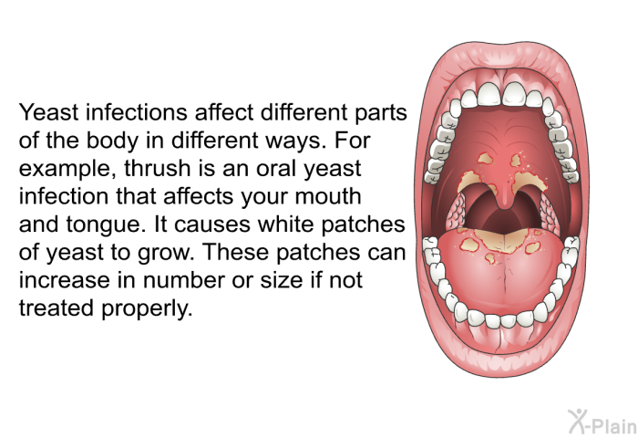 Yeast infections affect different parts of the body in different ways. For example, thrush is an oral yeast infection that affects your mouth and tongue. It causes white patches of yeast to grow. These patches can increase in number or size if not treated properly.