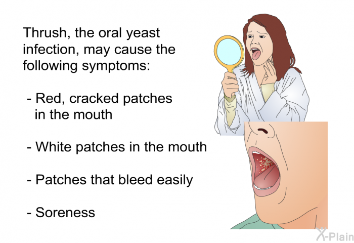 Thrush, the oral yeast infection, may cause the following symptoms:  Red, cracked patches in the mouth White patches in the mouth Patches that bleed easily Soreness