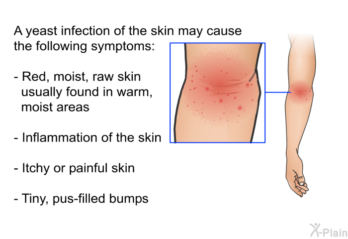 A yeast infection of the skin may cause the following symptoms:  Red, moist, raw skin usually found in warm, moist areas Inflammation of the skin Itchy or painful skin Tiny, pus-filled bumps