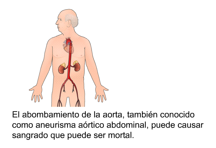 El abombamiento de la aorta, tambin conocido como aneurisma artico abdominal, puede causar sangrado que puede ser mortal.