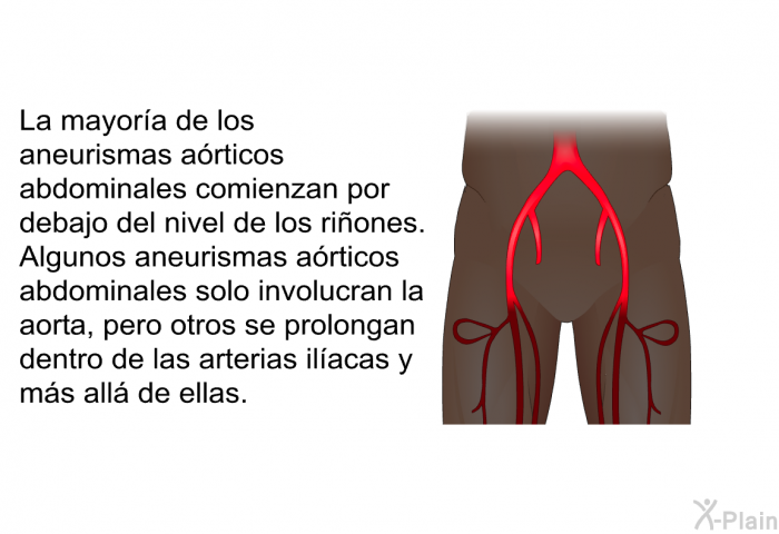 La mayora de los aneurismas articos abdominales comienzan por debajo del nivel de los riones. Algunos aneurismas articos abdominales solo involucran la aorta, pero otros se prolongan dentro de las arterias ilacas y ms all de ellas.