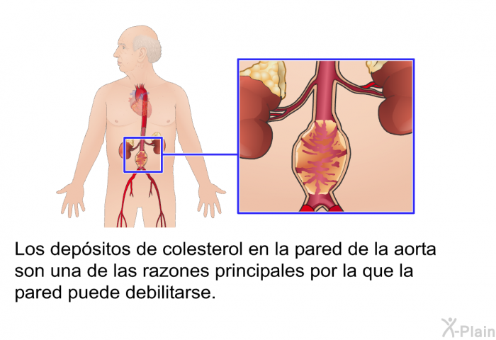 Los depsitos de colesterol en la pared de la aorta son una de las razones principales por la que la pared puede debilitarse.