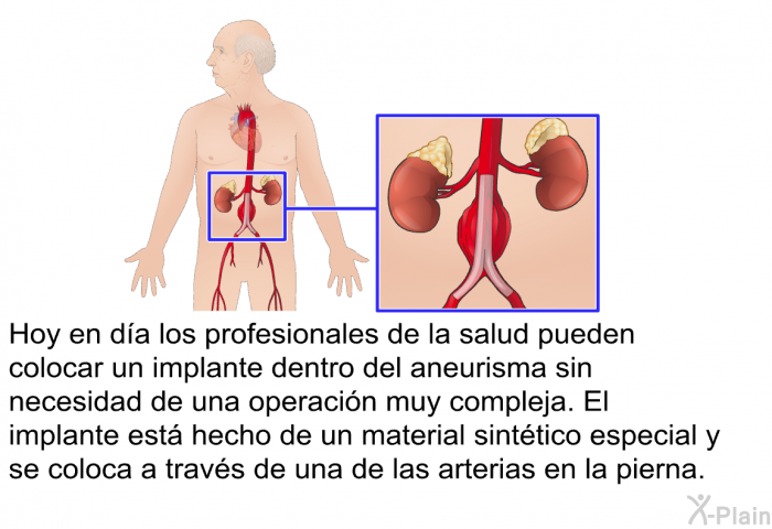 Hoy en da los profesionales de la salud pueden colocar un implante dentro del aneurisma sin necesidad de una operacin muy compleja. El implante est hecho de un material sinttico especial y se coloca a travs de una de las arterias en la pierna.