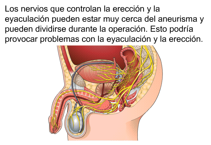 Los nervios que controlan la ereccin y la eyaculacin pueden estar muy cerca del aneurisma y pueden dividirse durante la operacin. Esto podra provocar problemas con la eyaculacin y la ereccin.